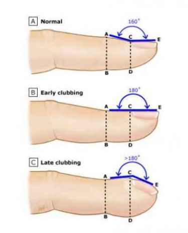 What are fingernail and toenail abnormalities?